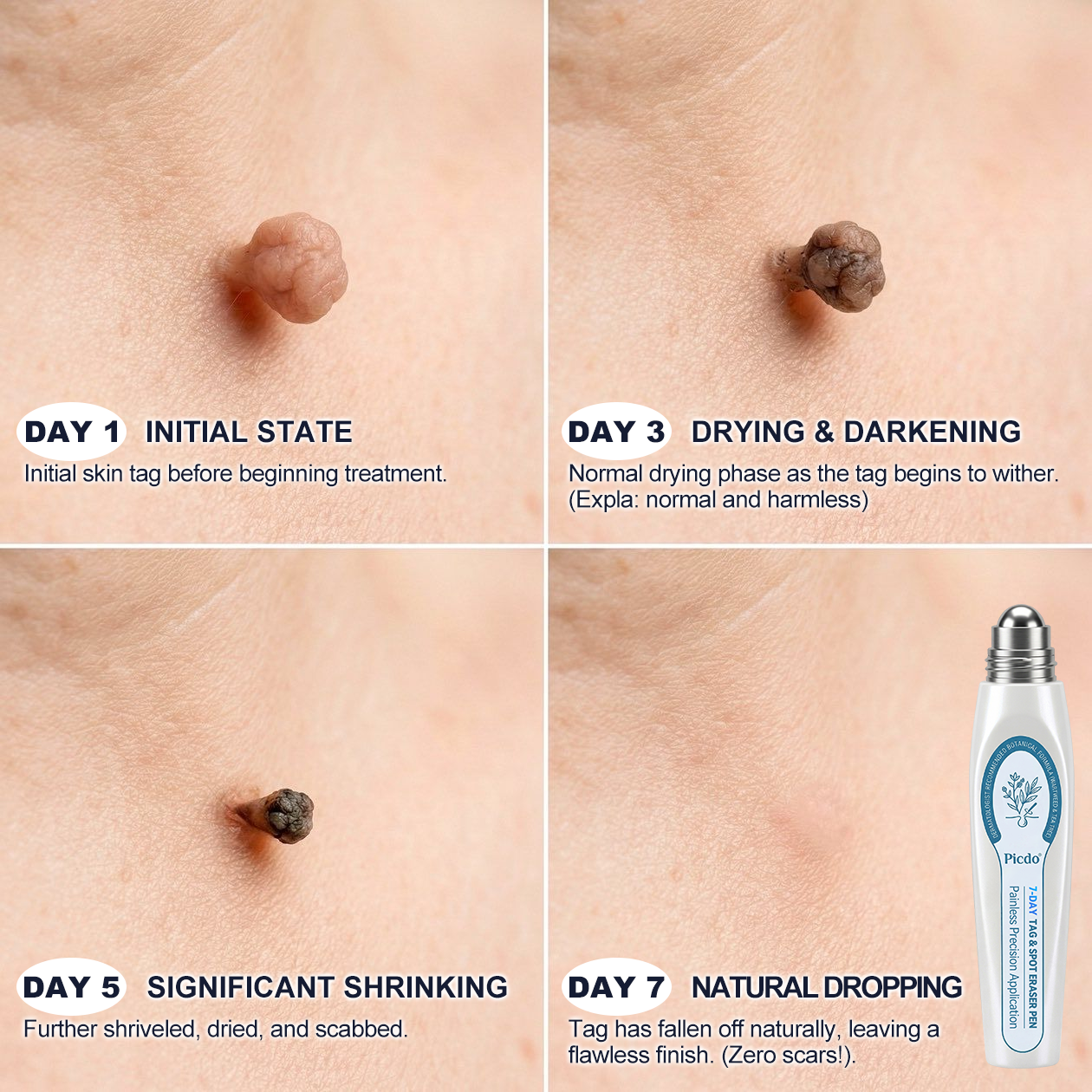 𝐏i𝐜𝐝o® 7-𝐷𝑎𝑦 𝗧𝐚𝐠 & 𝗦𝗽𝐨𝐭 𝐄𝐫𝒂𝒔𝒆𝒓(Zero Pain, Zero 𝐒𝐜𝐚𝒓𝒔 Rollerball)💪